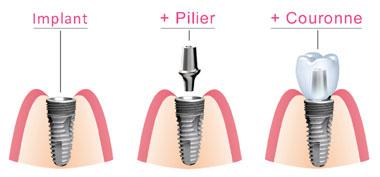 Composants implant dentaire Nice 06000